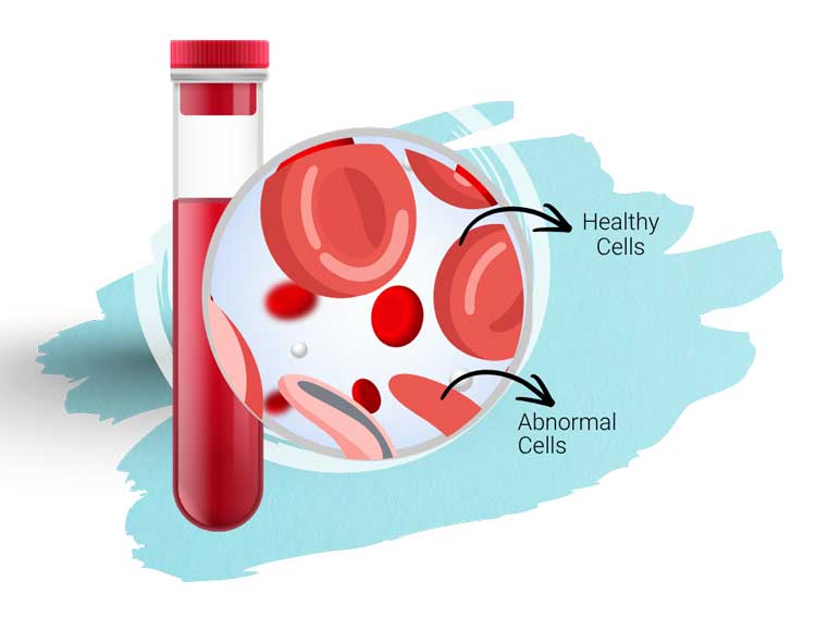 Understanding Sickle Cell & Anemia
